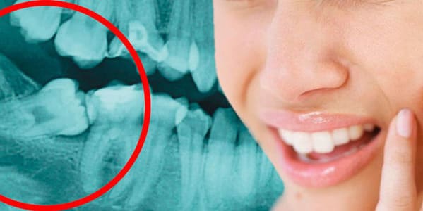 por que duele la muela del juicio