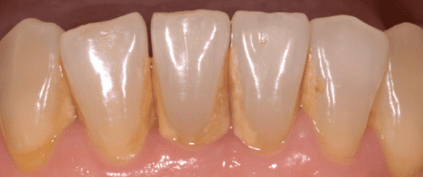 que es el sarro dental