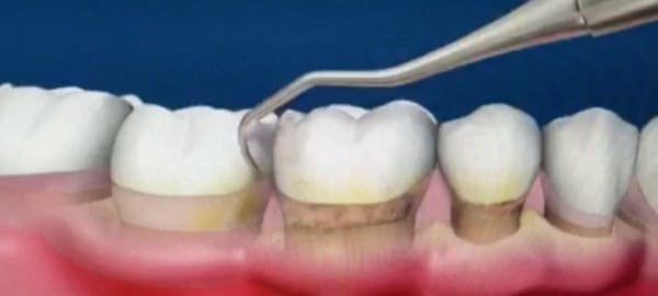 aspado radicular para eliminar el sarro