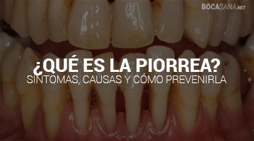 Qué es la Piorrea