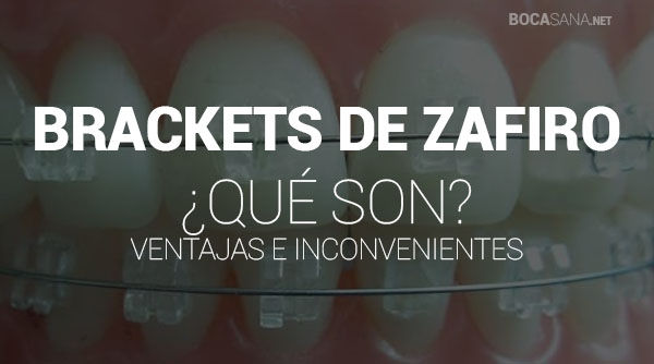 Brackets de Zafiro 【 Qué Son y Cuáles son Sus Ventajas 】