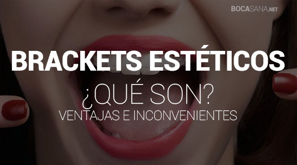 ¿Brackets Estéticos? 【 Ventajas e Inconvenientes 】