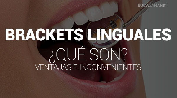 Brackets Linguales 【 Qué Son y Cómo Funcionan 】