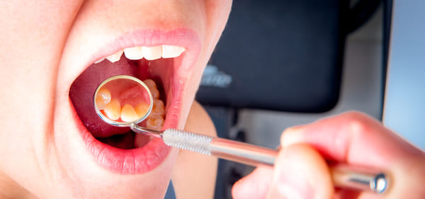 causas bulto en el paladar