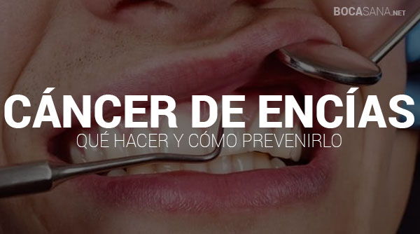 Cáncer de Encías 【Signos, Síntomas y Prevención 2025 】