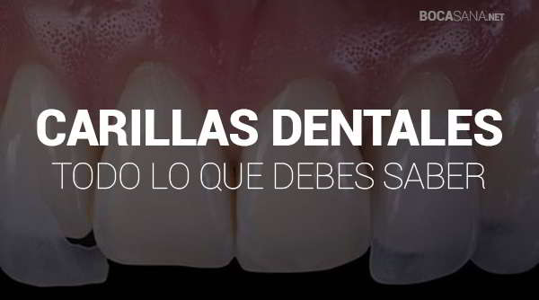 Carillas Dentales