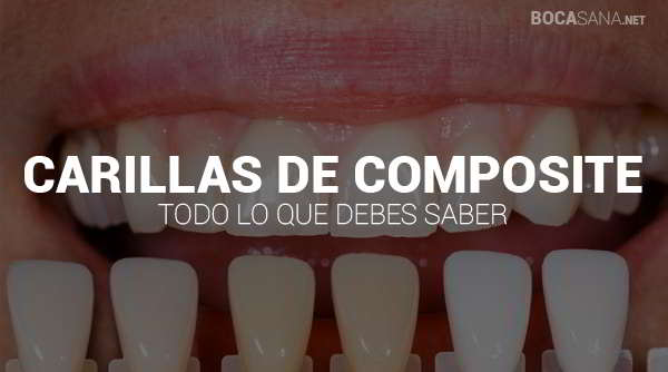 Carillas de Composite