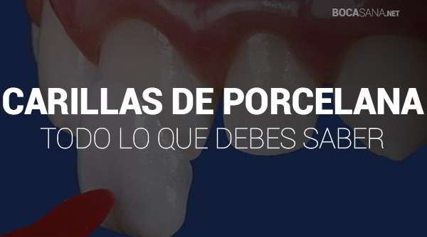 Carillas de Porcelana 【 Qué Son, Cuánto Cuestan y Qué Tipos Existen 】