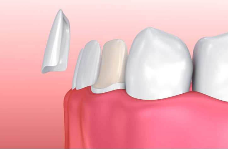 opiniones carillas dentales