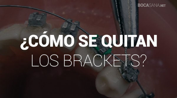 ¿Cómo Se Quitan los Brackets? 【 ¿Duele Hacerlo? 】