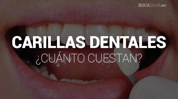 ¿Cuál es El Precio de las Carillas Dentales? 【 octubre 2025 】