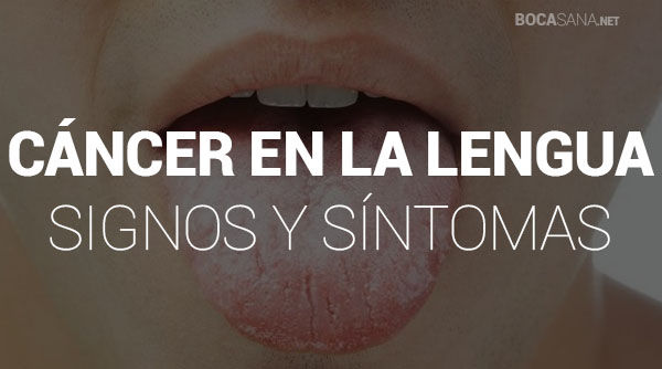 Cuáles son los Signos y 【 Síntomas del Cáncer de Lengua 】