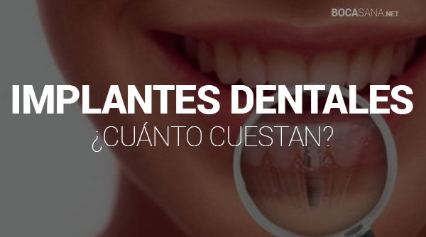 ¿Cuánto Cuesta un Implante Dental? 【Precios en el 2025】