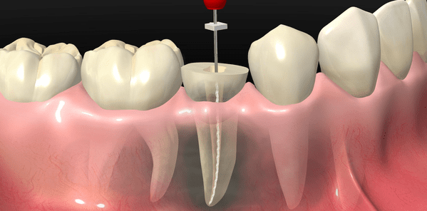 endodoncia dolor de encias