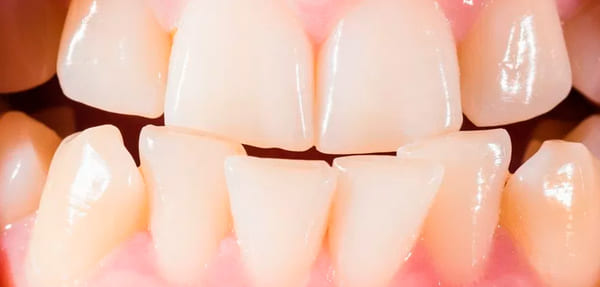 dientes mal alineados