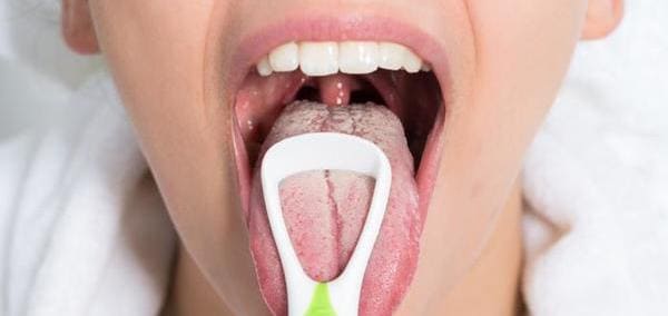 candidiasis oral