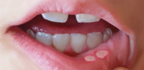 aftas dolor de encias