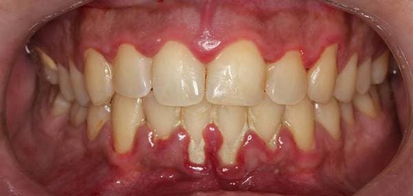 gingivitis dolor de encias