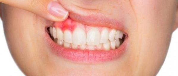 absceso dolor de encias