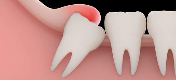 muelas del juicio dolor de encias