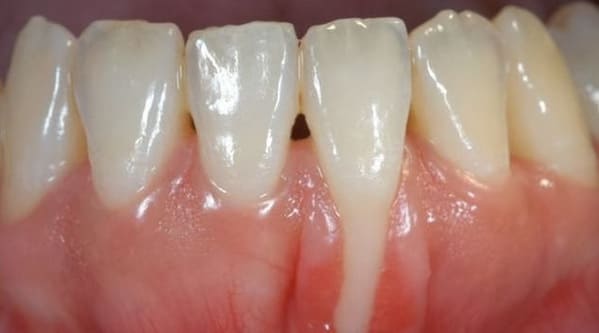 que son las encias retraidas