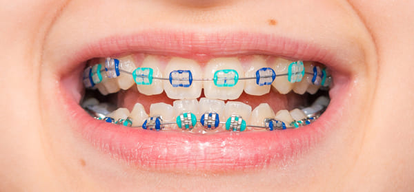 ortodoncia y encias retraidas