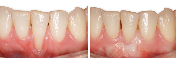 estiramiento de encias retraidas