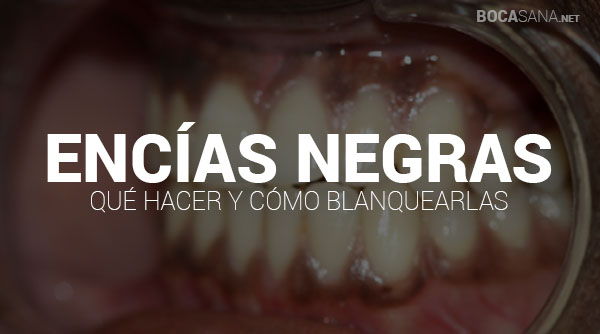 Encías Negras