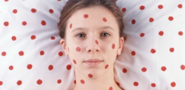 sarampion faringitis