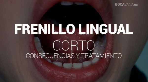 ¿Frenillo Lingual Corto? 【 Consecuencias y Tratamientos 】