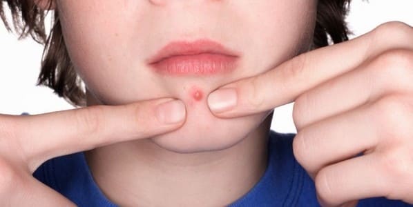 quitar granos en el labio