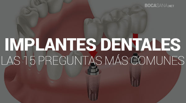 Implantes Dentales 【 Las 15 Preguntas Más Comunes 】