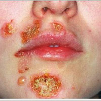 impetigo labio hinchado