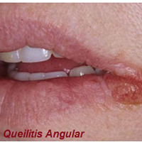 queilitis labio hinchado