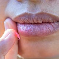 labios secos labio hinchado