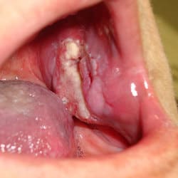 cancer oral