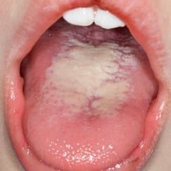 candiasis oral