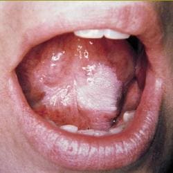 leucoplasia