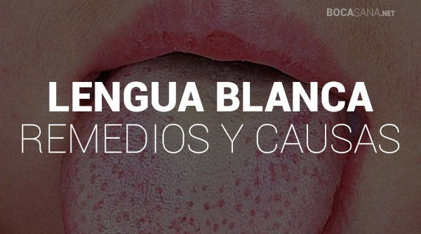 Lengua Blanca 【 Por Qué Ocurre y Qué Remedios Existen 】