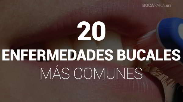 Enfermedades Bucales Más Comunes