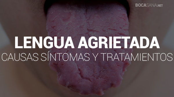 Lengua Agrietada