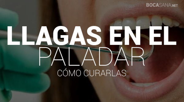 Llagas en el Paladar
