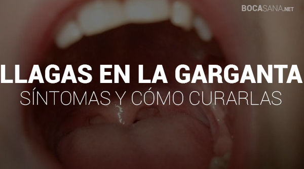 Llagas en la Garganta