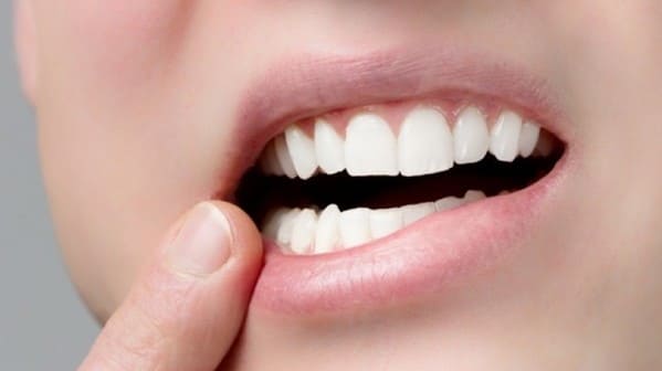 como curar las llagas en la encía