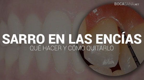 Sarro en las Encías
