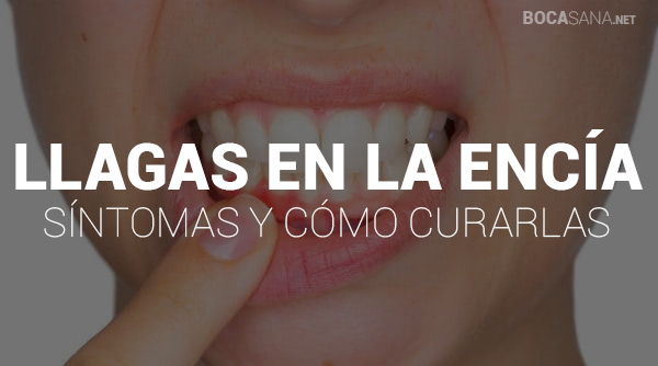 Llagas en la Encía 【 Cómo Curarlas y Por Qué Salen】