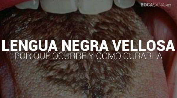 Lengua Negra Vellosa