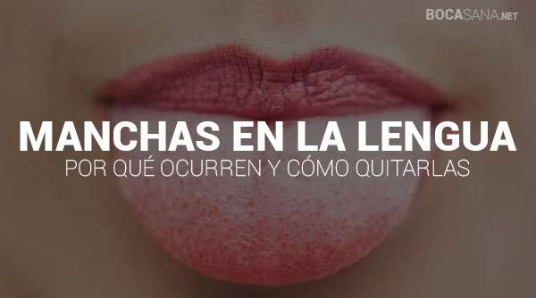 Manchas Rojas y Blancas en la Lengua【 Por Qué Ocurre y Qué Hacer 】