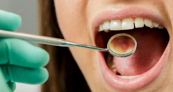 llagas en el paladar