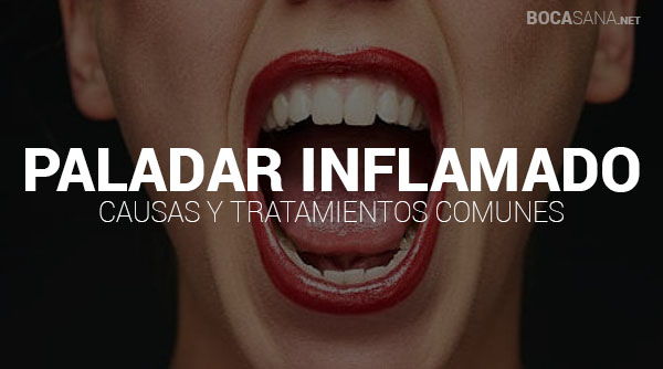 Paladar Inflamado